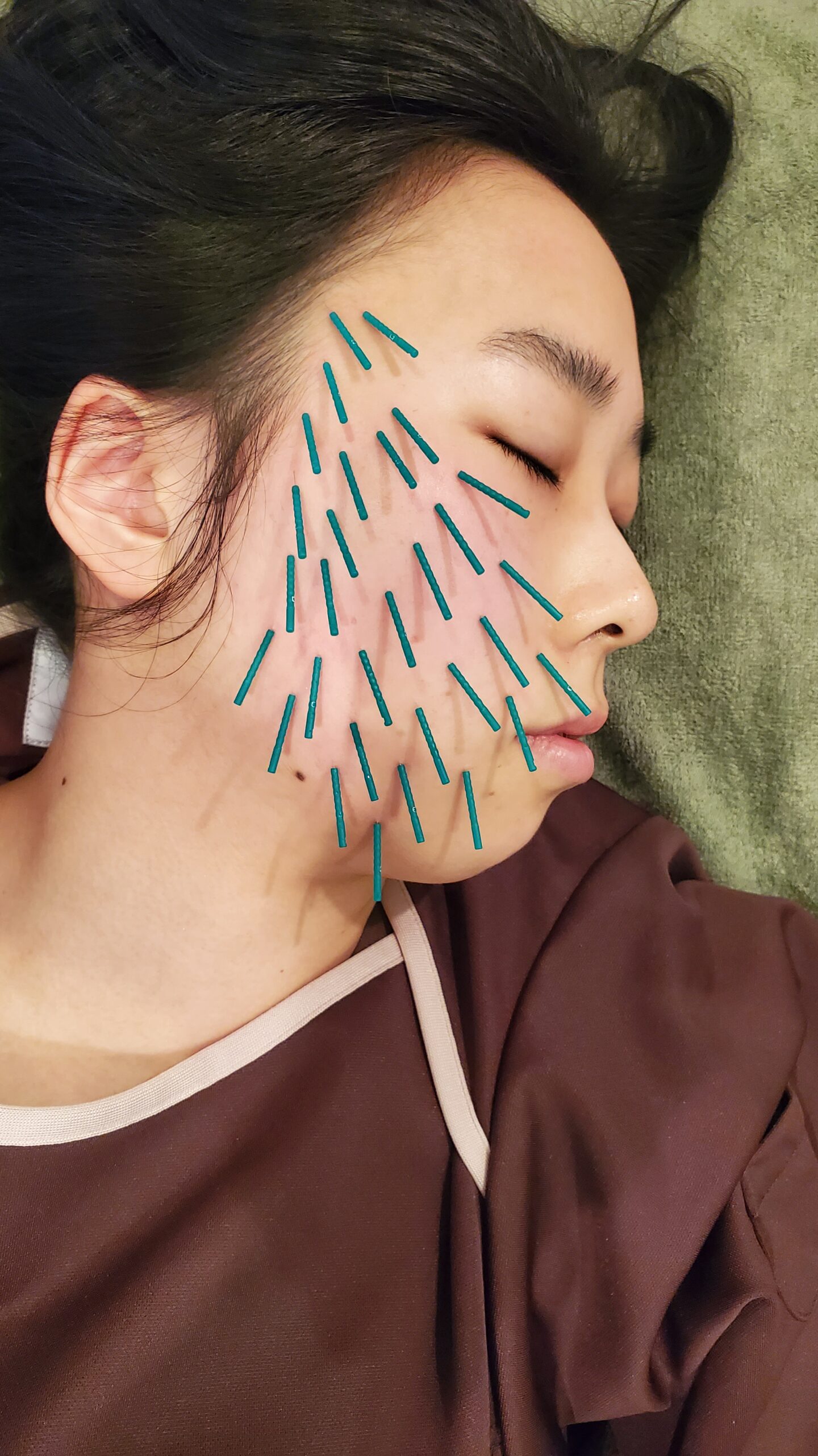 TCV法と特許技術ダーマリペアシート