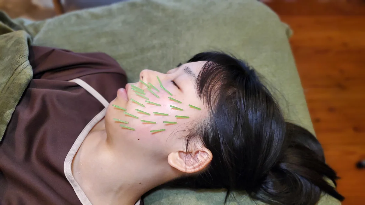 顔のラインに沿って鍼を配置するTCV法™美容鍼
